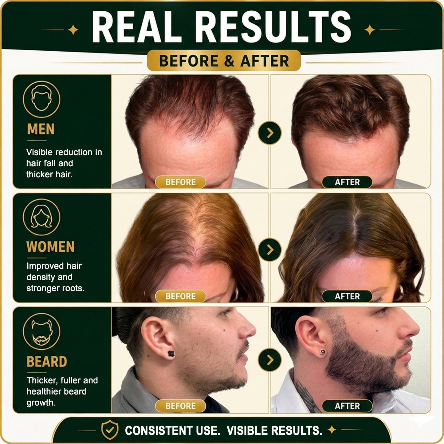 5% Minoxidil Hair Growth Treatment for Men - Extra Strength Topical Solution USP 5 Percent for Hair Loss, Hair Regrowth, Thinning Hair & Receding Hairline - Fast Hair Growth Serum with Dropper Applicator for Beard Growth & Fuller Thick Hair, 3 x 60mL