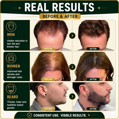 5% Minoxidil Hair Growth Treatment for Men - Extra Strength Topical Solution USP 5 Percent for Hair Loss, Hair Regrowth, Thinning Hair & Receding Hairline - Fast Hair Growth Serum with Dropper Applicator for Beard Growth & Fuller Thick Hair, 3 x 60mL